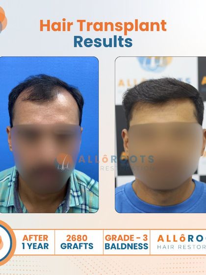 A one-year result for a Grade 3 baldness case using 2680 grafts. These images show the transformation from multiple angles, highlighting the restored density and the clean, natural hairline I designed.