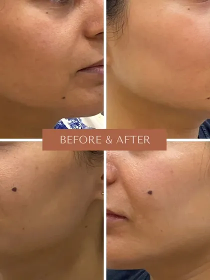 These images demonstrate the 'glass skin' effect achievable with AdvaTx. The treatment refines pores and smooths texture, creating a filter-like finish with zero downtime.