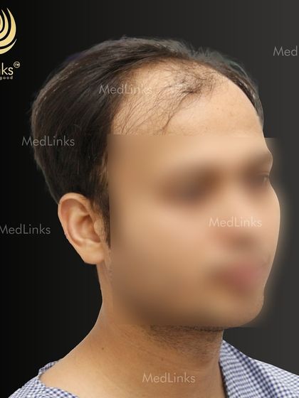 The patient's hair from the side before the procedure.