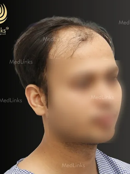 The patient's hair from the side before the procedure.