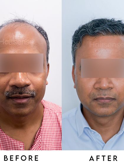A frontal before and after shot that captures the patient's renewed sense of self. The change is not just in the hair, but in his expression.