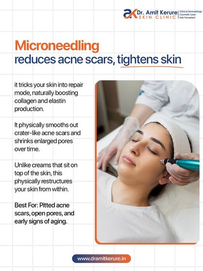This infographic details how microneedling works to reduce acne scars and tighten skin by tricking your skin into its natural repair mode, boosting collagen and elastin.