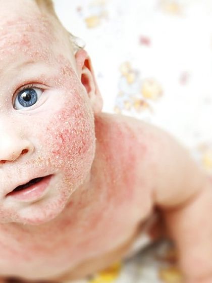 This infant is experiencing atopic dermatitis, or eczema, a common condition in babies. My approach is to soothe the inflammation with gentle, safe treatments and educate parents on how to manage the condition at home to prevent flare-ups.