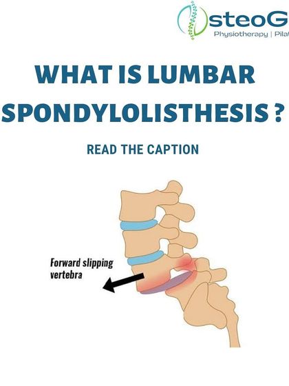 Lumbar Spondylolisthesis is a spinal disorder where a vertebra slips forward. It is often seen in athletes in sports like gymnastics and football that stress the lower back. This diagram shows exactly what happens in the spine.