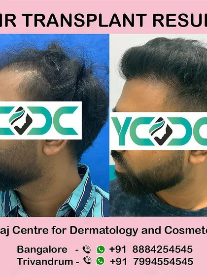 This side view highlights the natural flow and density achieved post-transplant, blending perfectly with the patient's original hair.