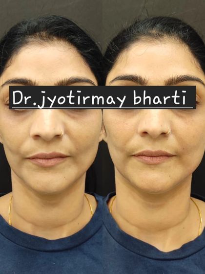 This before and after image showcases the subtle yet significant results of facial fillers. The treatment has helped to lift the cheeks and define the jawline, creating a more structured and youthful facial contour.