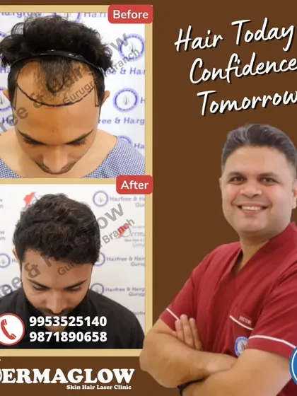 This before-and-after shows the result of a 2688-graft FUE transplant after 9 months. We successfully addressed significant hair loss across the top of the scalp, creating a dense and age-appropriate hairline.