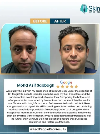 This is the result of a partnership between a patient and a surgeon. This patient's review highlights the importance of a meticulous approach to achieve a natural hairline and optimal density. The before and after pictures show a complete and youthful transformation.