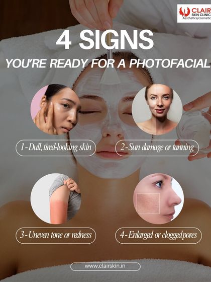 Here are four signs you're ready for a PhotoFacial, from dull skin and sun damage to enlarged pores. This treatment is designed to restore your skin's natural radiance.
