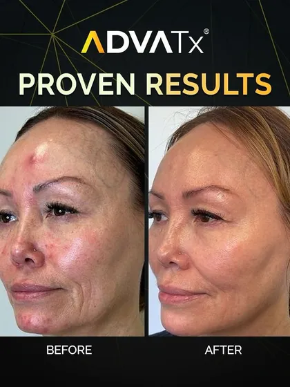 This before-and-after demonstrates the power of the AdvaTx laser. Notice the significant improvement in skin texture, reduction in redness, and overall rejuvenation after a tailored treatment course.