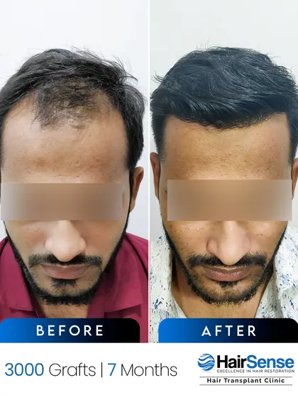 A top-down view after 7 months, illustrating the high-density packing we achieved to cover the thinning crown and mid-scalp.