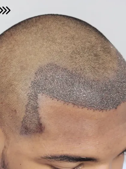 Fresh graft placement for a Grade 2 case. We used 2400 grafts to recreate the hairline, enhance the frontal region, and design natural temples.