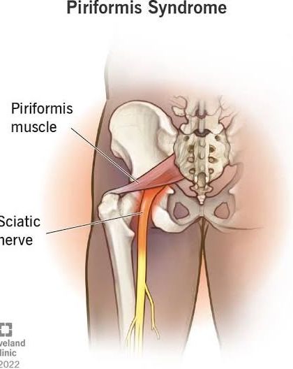 Piriformis Syndrome occurs when the piriformis muscle in the buttock compresses the sciatic nerve, causing pain. This diagram shows the relationship between the muscle and nerve, helping you understand the source of the pain.