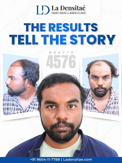 Mr. Vishal came to me ready for a permanent change. I addressed his significant hair loss by transplanting 4,576 grafts, creating a full and dense result that ensures he no longer has to worry about thinning hair. The confidence in his eyes says it all.