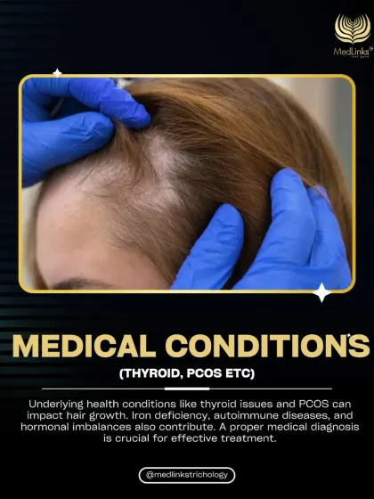 Underlying medical conditions like thyroid issues, PCOS, and iron deficiency can also cause hair loss. A proper medical diagnosis is essential for effective treatment.
