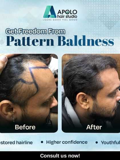 We provide effective solutions for male pattern baldness. This client's hairline was redesigned and restored, resulting in a more youthful look and a significant boost in confidence.