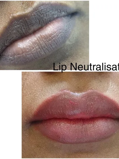 Another powerful before and after of a lip neutralization. This treatment is perfect for anyone who feels their lips are dark or unevenly toned and wants a natural solution.