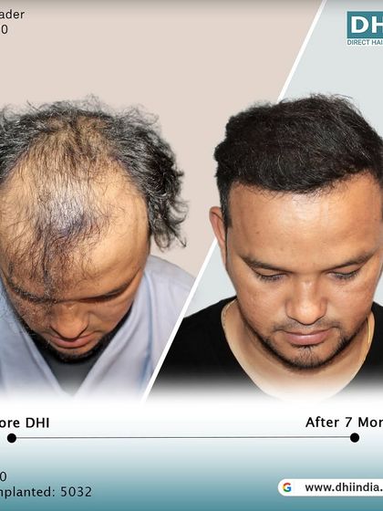 A top-down view of the 7-month transformation. This image clearly shows the significant improvement in coverage and density across the scalp, demonstrating the effectiveness of our DHI procedure.