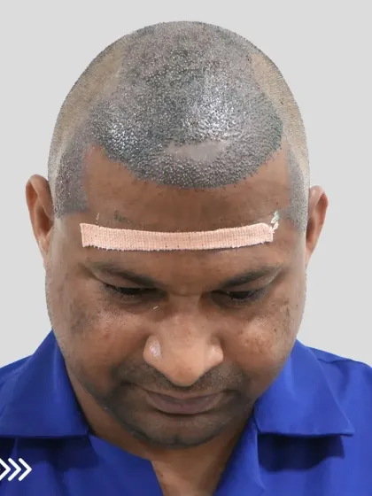 This is what a scalp looks like immediately after the procedure. Each dot is a carefully placed graft, the foundation of a future full head of hair.