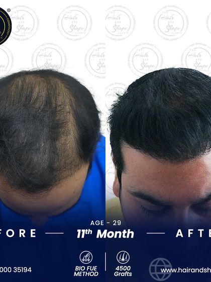 This top-down view at 11 months shows the comprehensive coverage achieved with the BIO FUE method, eliminating signs of thinning.