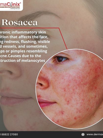 An image showing Rosacea, a chronic inflammatory condition causing redness and flushing. It's important to get a proper diagnosis as it can be mistaken for other conditions.