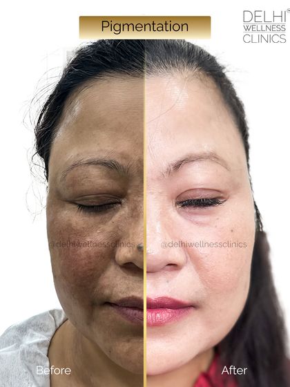The split-screen view of this client's pigmentation treatment journey highlights the effective removal of dark patches and the restoration of an even skin tone.