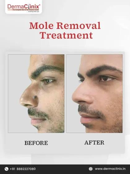 This before and after shows the result of our mole removal treatment. The procedure is performed with precision by our dermatologists to ensure a clean, scar-free outcome, enhancing the patient's natural features.