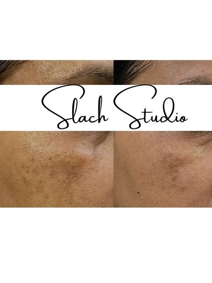 This before-and-after shows the successful treatment of patchy pigmentation, leading to a more even and consistent skin tone.