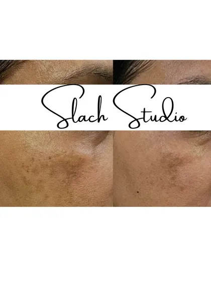 This before-and-after shows the successful treatment of patchy pigmentation, leading to a more even and consistent skin tone.