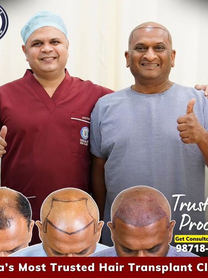 Trusting the process is key. This patient with Grade 7 baldness received 3400 grafts. The images show the careful planning and the immediate result after the procedure, setting the foundation for future growth.