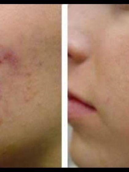 This transformation showcases the effectiveness of a multi-session approach to acne scar removal. Patience and consistency, guided by expert care, lead to remarkable improvements in skin texture.