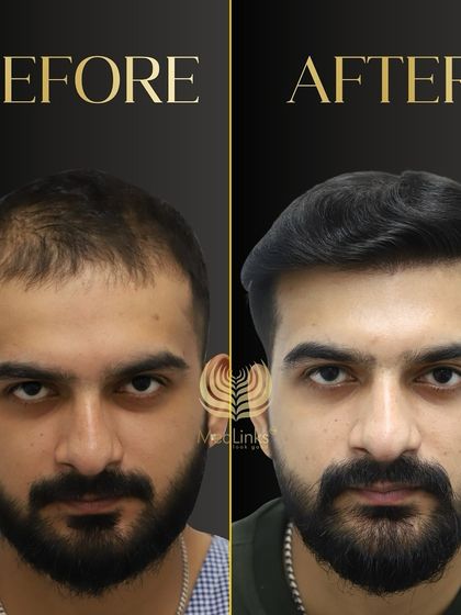 A great before and after transformation. The patient's new hair looks natural, dense, and has completely revitalized his appearance.