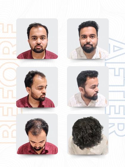 Shardul Kamthe knew it was time to take control of his receding hairline. I restored his natural look with 4,879 grafts using the RT-FUE technique, which maximizes graft survival and delivers density that looks and feels completely natural.