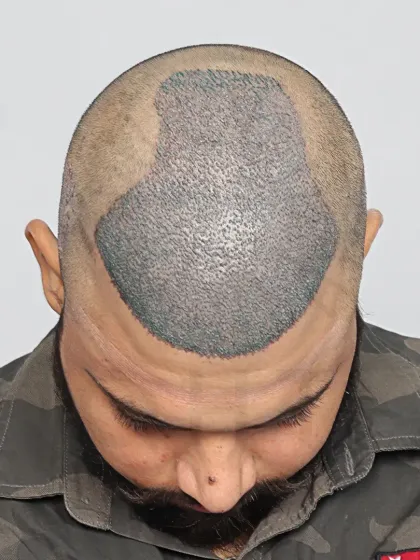 This is what a scalp looks like immediately after the procedure. Each dot is a carefully placed graft, the foundation of a future full head of hair.