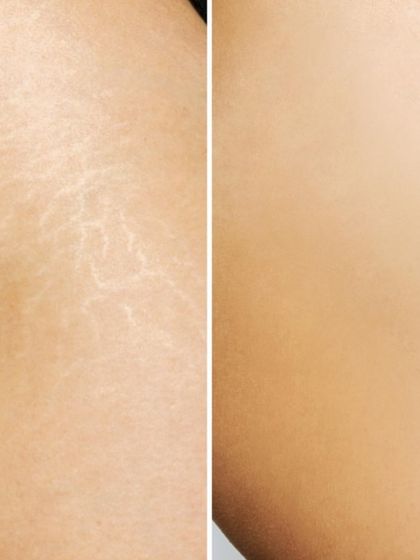 This before-and-after illustrates the potential improvement in the appearance of stretch marks. My treatments focus on stimulating repair in the dermal layer to make the marks less visible over time.