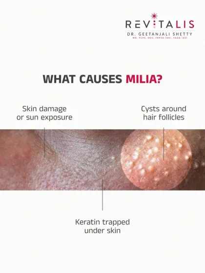 What Causes Milia to Form? Milia can be caused by sun damage, the use of heavy skin products, or cysts around hair follicles. Understanding the cause is the first step to effective treatment.