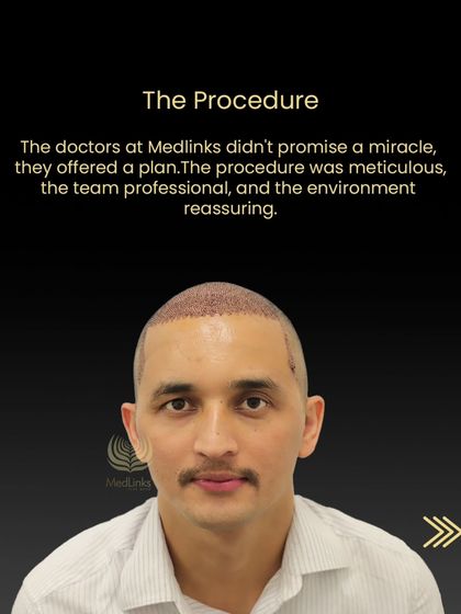 The procedure for Tika Ram, immediately after the grafts were placed. Our team ensured the process was professional and reassuring.