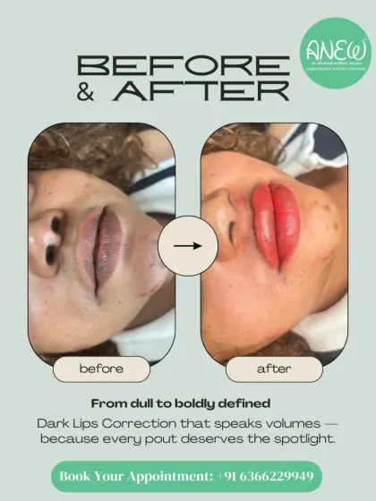 From dull to boldly defined. Our Dark Lips Correction treatment uses advanced techniques to address hyperpigmentation on the lips, restoring a natural, vibrant, and even-toned pout that deserves the spotlight.