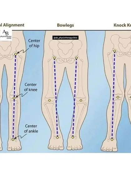 This diagram shows the difference between normal alignment, bowlegs, and knock knees. These structural variations can contribute to knee and hip pain, and we can provide exercises to help manage them.