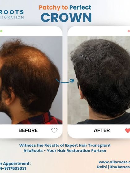 Crown area thinning is a common concern. These images show a perfect restoration of the crown, transforming a patchy area into a full, dense look that blends seamlessly with the surrounding hair.
