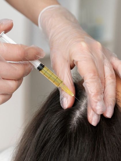 Here is a close-up of a PRP injection being administered to the scalp. The procedure is precise and targets areas of thinning to revitalize hair follicles. It is a safe and minimally invasive way to encourage natural hair regrowth.