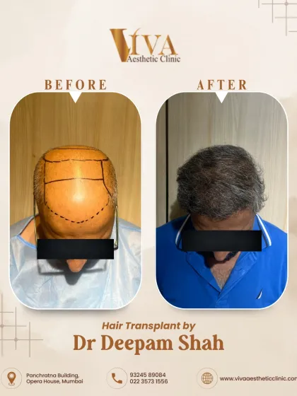 A top-down view of the 7500-graft procedure. You can see the extensive area we planned to cover, and the final result is a full head of hair with natural density after 10 months.