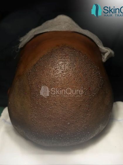 Hair transplant is an art form. This image shows the scalp immediately after the placement of thousands of grafts. Each one is meticulously placed to ensure the correct density and direction, laying the groundwork for a completely natural result.