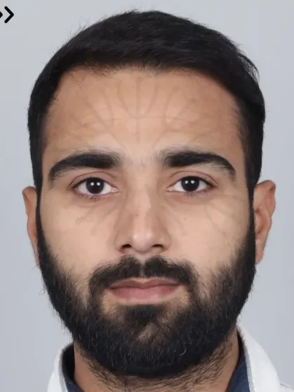 This is a 16-month result for a Grade 5A case, achieved with 5000 grafts. A true comeback story.
