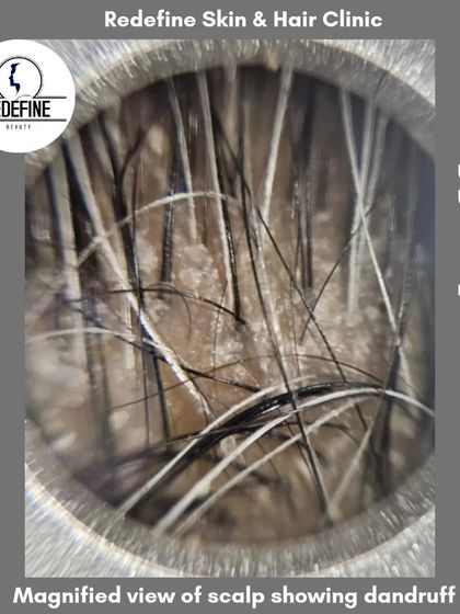 This is a magnified view of a scalp with dandruff. Understanding the problem at a microscopic level helps us provide effective, targeted treatments to eliminate flakes, reduce itching, and restore scalp health.