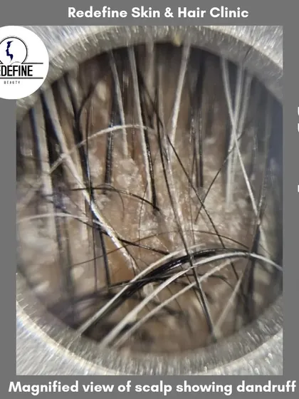 This is a magnified view of a scalp with dandruff. Understanding the problem at a microscopic level helps us provide effective, targeted treatments to eliminate flakes, reduce itching, and restore scalp health.