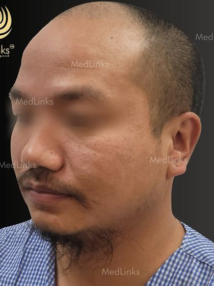 The patient's hair from the side before the procedure.