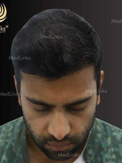 The top-down view after the transplant, showcasing the full coverage achieved.