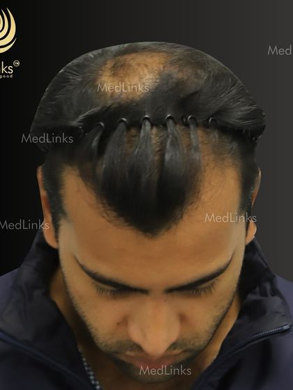 A top-down view showing the hair parted and ready for the procedure. This is where the journey to renewed confidence begins, with a plan tailored to achieve a natural, dense result.