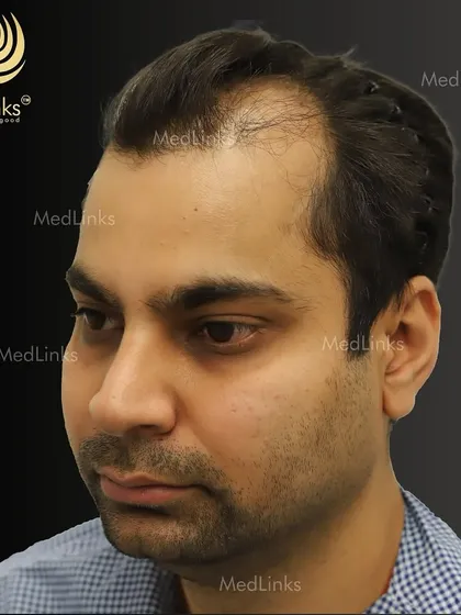 The patient's hair from the side before the procedure.